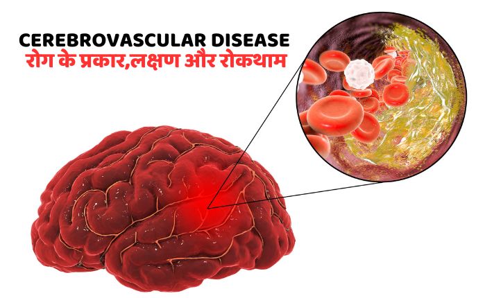 cerebrovascular disease रोग के प्रकार,लक्षण और रोकथाम